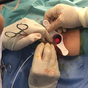 Laser 980nm 1470nm for Hemorrhoids Polyps and Anal Fissures Hemostasis Cutting Coagulation Laser