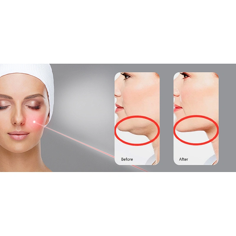 2023 New Technology Surgical Laser Liposuction Machine Cannula Endolaser