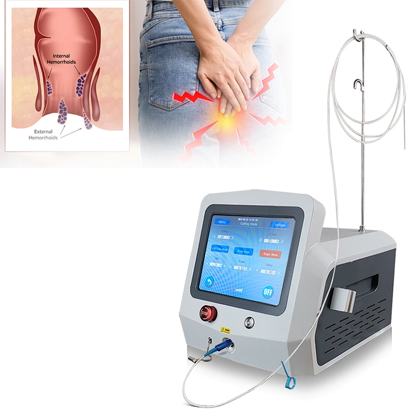 2025 Hot Sale 980nm1470nm Diode Laser Proctology Hemorrhoids Anal Fistula Fissure Sinus Pilonidalis Treatment Device