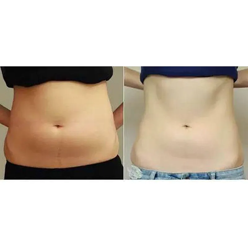 Newest 980nm Diode Laser Liposuction Laser Lipolysis Anti Cellulite Weight Laser Endolaser Lift