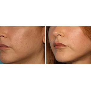 Aesthetic Medicine Laser 980nm Liposuction Device Vaser Fat Removal Lipomas Beauty Machine Liposuction Surgery Laser
