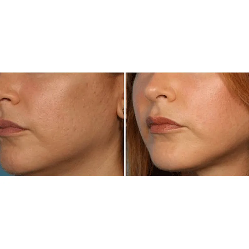 Aesthetic Medicine Laser 980nm Liposuction Device Vaser Fat Removal Lipomas Beauty Machine Liposuction Surgery Laser