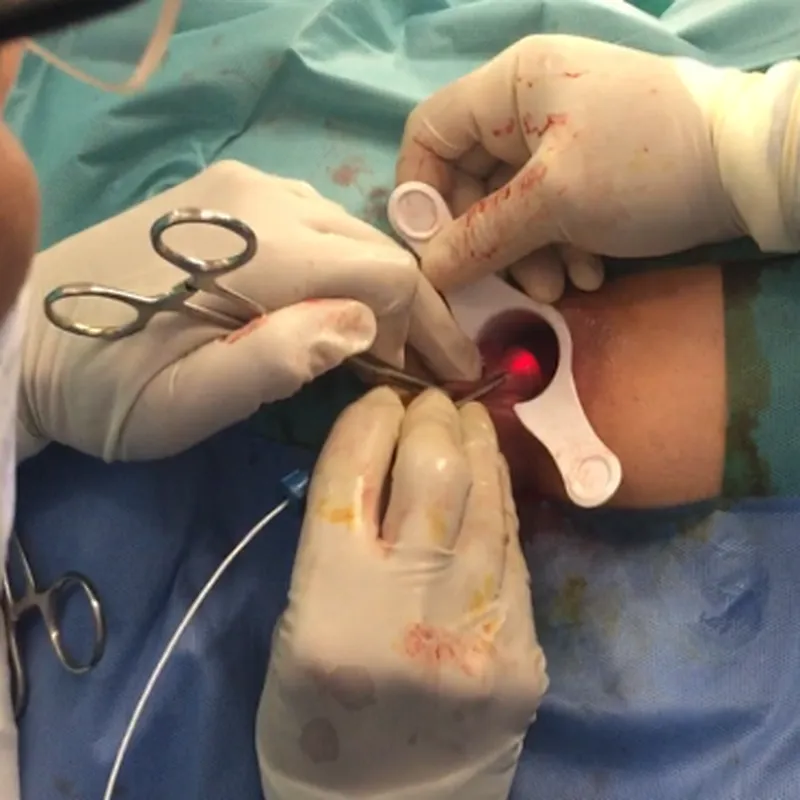 Less Bleeding Surgery Fiber Cutting Proctology Surgery Haemorrhoids Piles Blood Vessels Cutting Diode Laser 980nm LASER