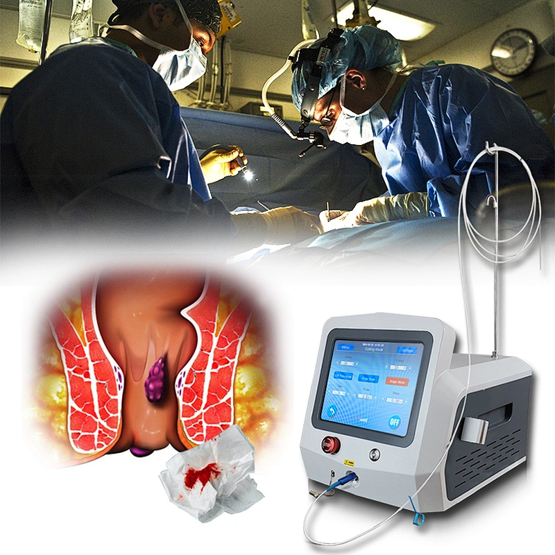 2025 Hot Sale 980nm1470nm Diode Laser Proctology Hemorrhoids Anal Fistula Fissure Sinus Pilonidalis Treatment Device