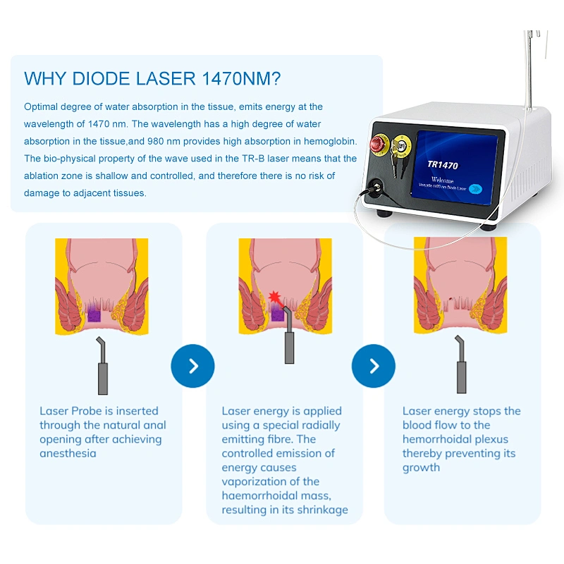 980nm 1470nm Hemorrhoidsurgery Haemorrhoids  Piles Fissure and Fistula Laser Machine
