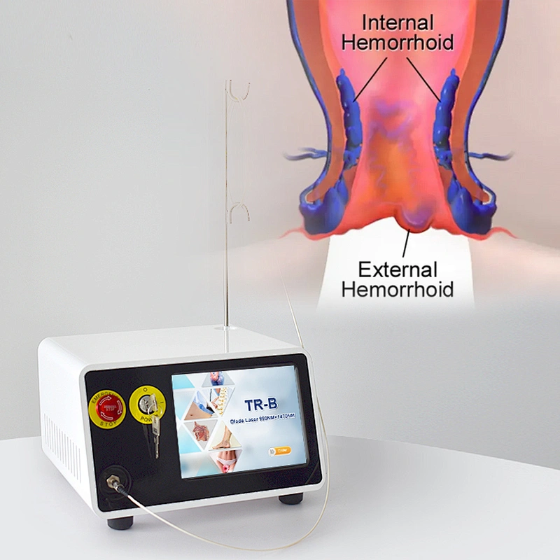 Dual Wave 980nm 1470nm Diode Laser Treatment Hemorrhoid and Hemorrhoid Cutting