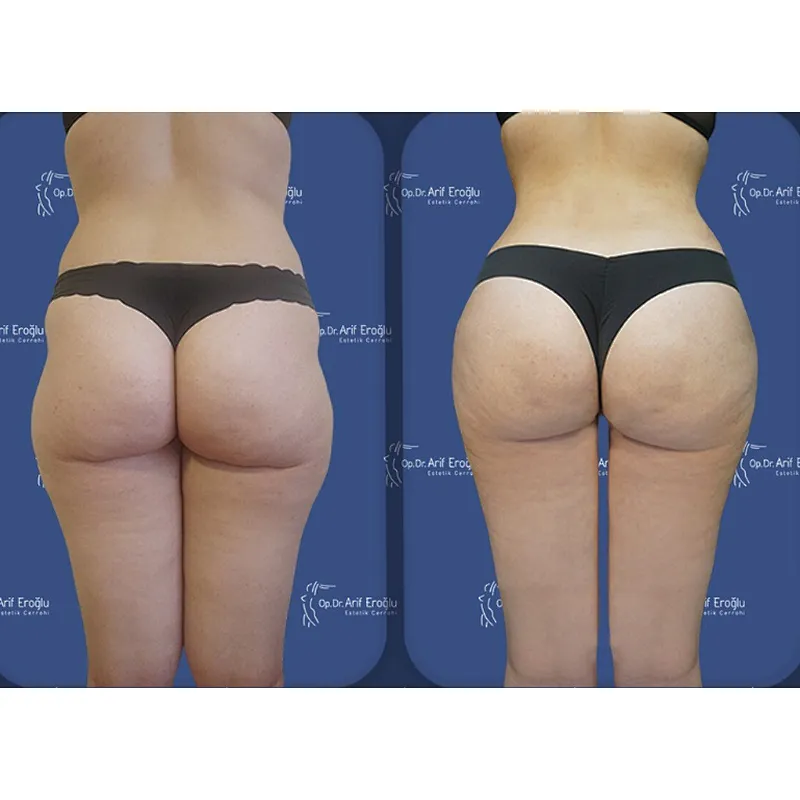 Triangel 980nm Laser Skin Tightening Eyebags  Lipolysis  Machine