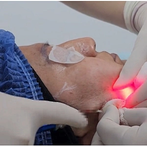 Triangel Laser Lipolysis 980nm Medical Liposuction Machine Endo Laser Fat Melting Lift Facial Equipment