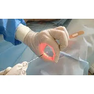 Less Bleeding Surgery Fiber Cutting Proctology Surgery Haemorrhoids Piles Blood Vessels Cutting Diode Laser 980nm LASER