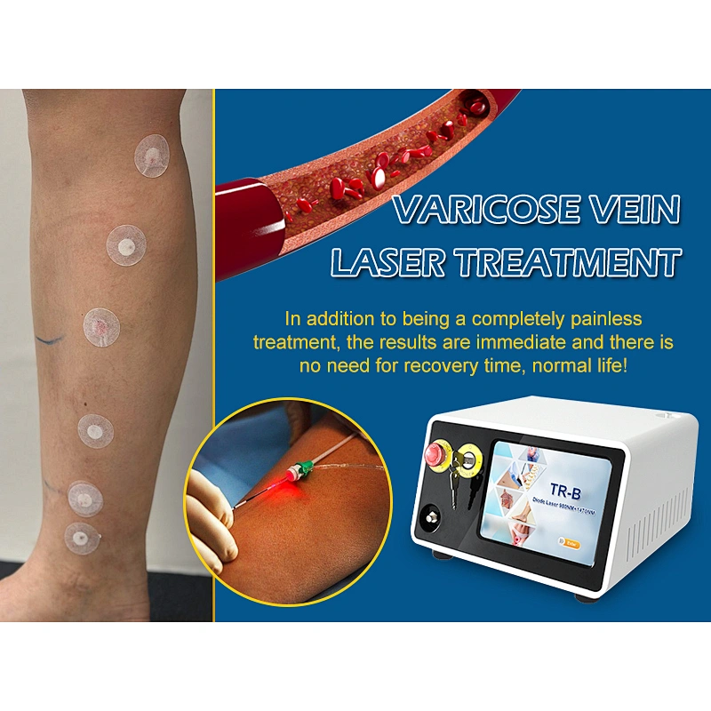 Triangel 1470nm Varicose Veins Laser EVLT EVLA Laser Machine