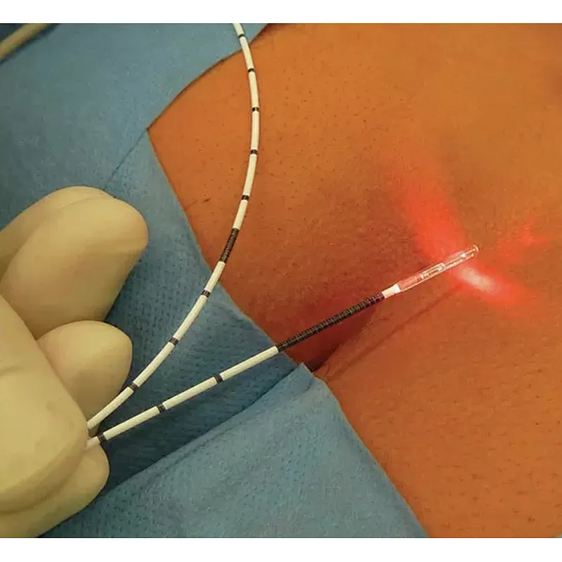 German Latest Tech Proctology Surgical Painless Hemorrhoidectomy Diode Laser 980nm 1470nm Piles Hemorrhoids Laser