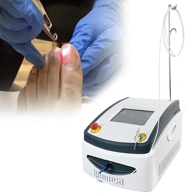 Laser Podiatry Onychomycosis Nail Fungus Treatment Diode Laser 1064 980 nm Fungal Nail Laser Machine