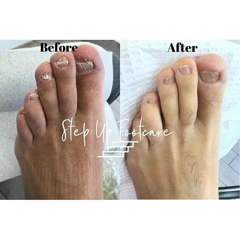 Laser Podiatry Onychomycosis Nail Fungus Treatment Diode Laser 1064 980 nm Fungal Nail Laser Machine
