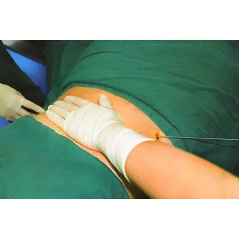 980nm  Face Lift Minimally Invasive Laser Endolaser Cellulite Treatment Machine