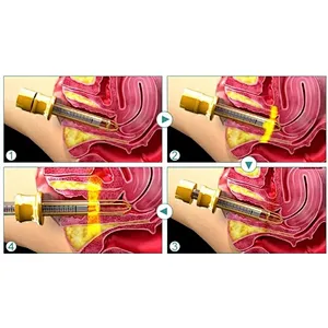 TAZLASER 2025 New Class IV  Diode Laser 1470nm 980nm Laser Vaginal Rejuvenation Vaginal Tightening Equipment