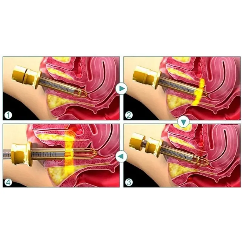 TAZLASER 2025 New Class IV  Diode Laser 1470nm 980nm Laser Vaginal Rejuvenation Vaginal Tightening Equipment