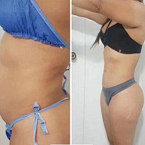 Diode Laser 1470nm 980nm Laser Fiber EndoLaser Cellulite Removal Facelifting 1470nm Laser Machine