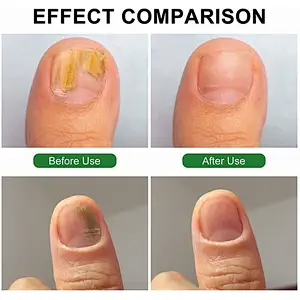 Hot Sale Nail Fungus Treatment Laser 1064nm Onicomicosis Fungus Nail Toenail Fungus Onicomicose Laser 980 nm 1210nm Machine