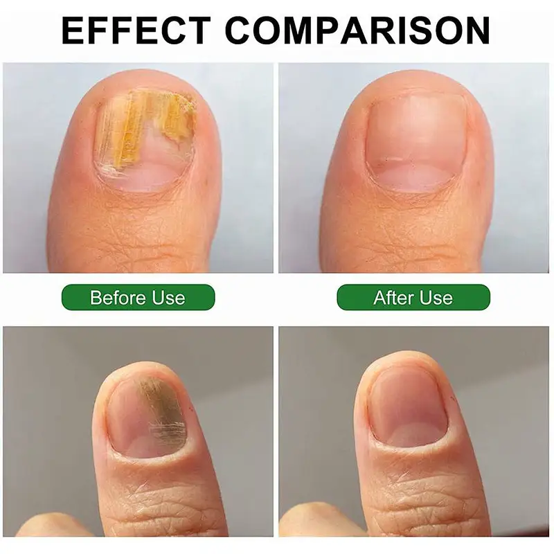 Hot Sale Nail Fungus Treatment Laser 1064nm Onicomicosis Fungus Nail Toenail Fungus Onicomicose Laser 980 nm 1210nm Machine