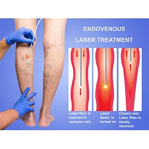980nm EVLT Varicose Vein Laser Treatment 1470nm Diode Fiber Laser Mini-invasive EVLT Surgery