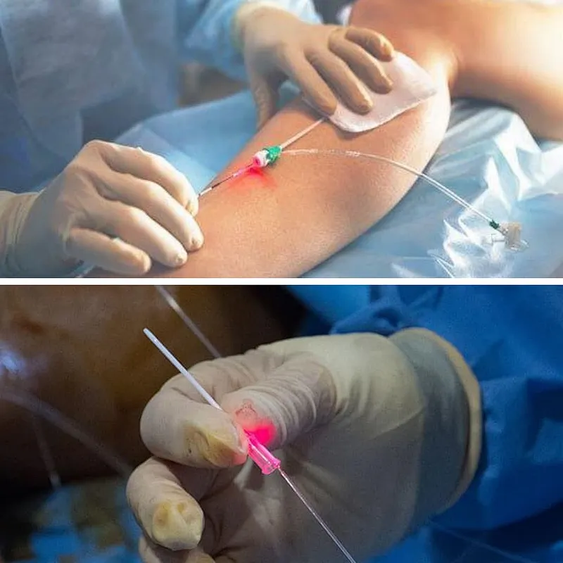 Factory Supply Best Quality EVLT Laser Varicose Veins Removal High Power Varicosity Treatment for Sale