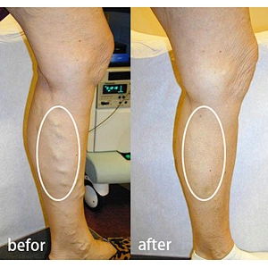 2024 Hot Sale Diode Laser 980 1470nm Evla Varicose Veins Treatment Machine