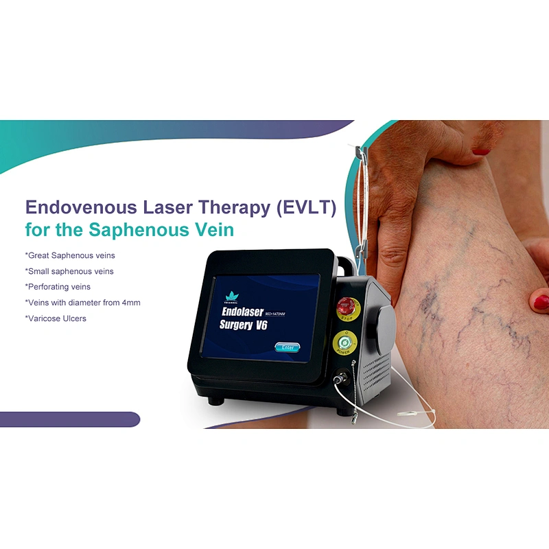 Dual Wave 980nm Class Iv Surgical Laser Equipment for Varices Des Membres Inferieurs Varicose Veins Evlt  Evla Varice