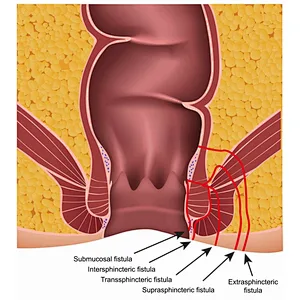Hemorrhoids Ectomy Laser Surgery 1470nm 980nm Fistulas Diode Laser Treatment Machine Proctology Laser
