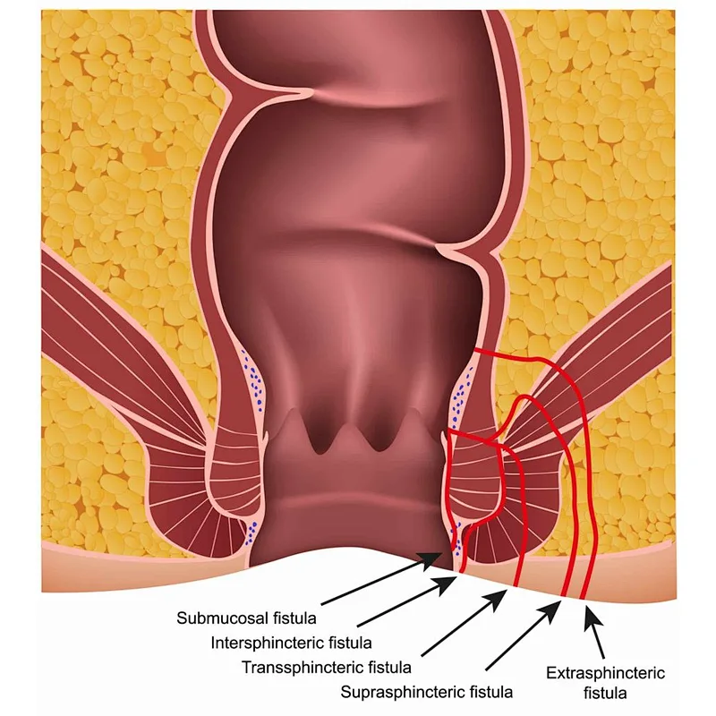 Hemorrhoids Ectomy Laser Surgery 1470nm 980nm Fistulas Diode Laser Treatment Machine Proctology Laser