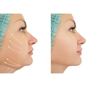 Hot Sell Surgery Dual-Wavelength Laser 980nm+1470nm Skin Lift Liposuction Fat Ablation Laser Machine Lipolysis