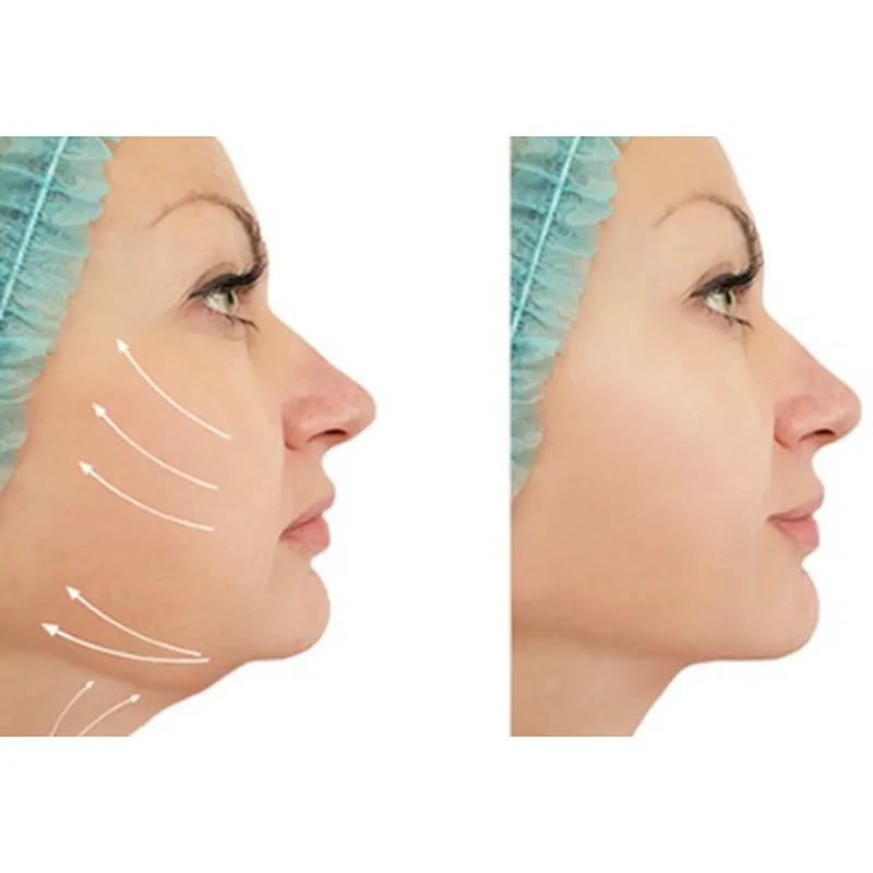 Hot Sell Surgery Dual-Wavelength Laser 980nm+1470nm Skin Lift Liposuction Fat Ablation Laser Machine Lipolysis