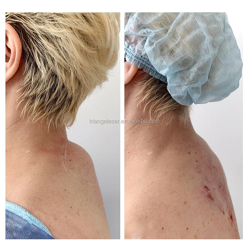Tazlaser TR-B 980nm 1470nm Vaser Liposuction Machine Endolaser Papada Lipolysis and Facial Lifting