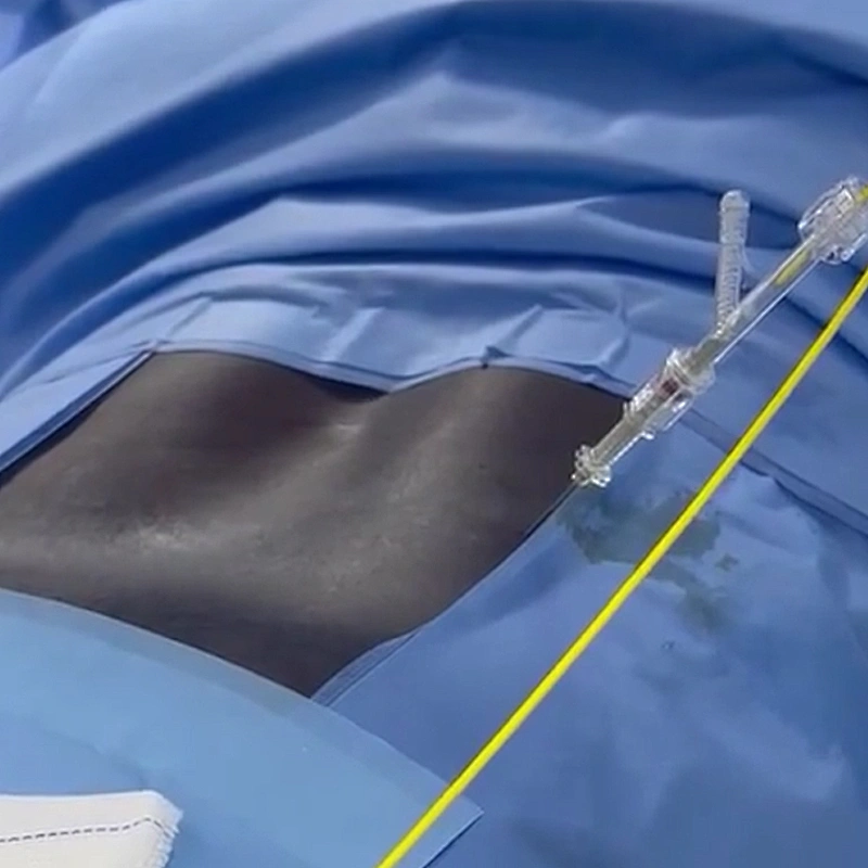 2024 Innovative Portable Diode 980 1470 nm Laser for PLDD Laser Treatment