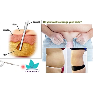 Medical Equipment Liposuction Diode Laser 980nm 1470nm Cannula Cannula Liposuction