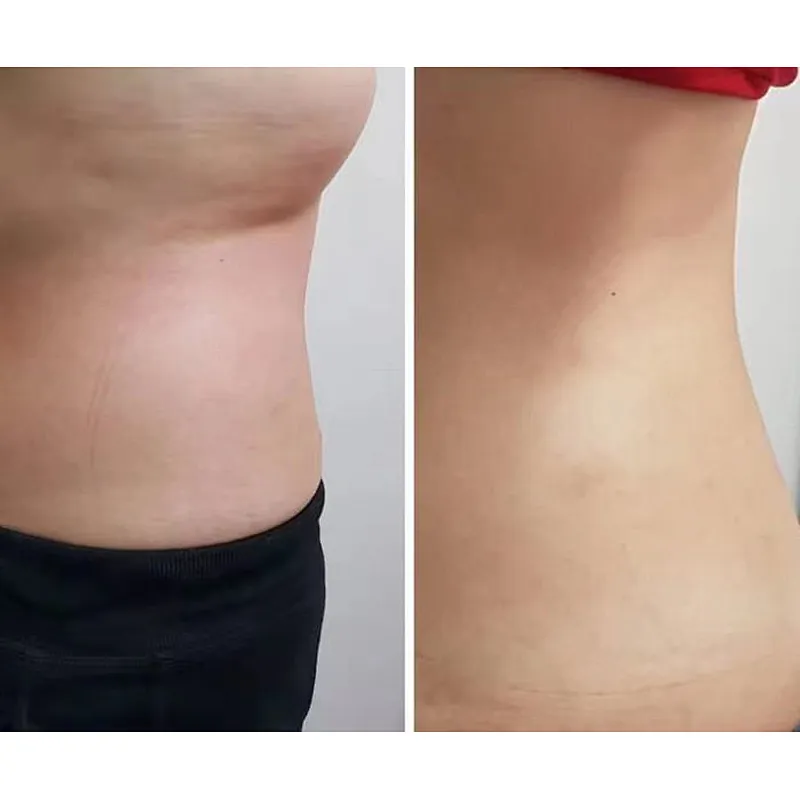 Assisted Surgical Liposuction 1470nm Lift Face Endo Laser Optic Fibers Laser Lipolysis Laser Diode 980 Nm Surgery Plastic
