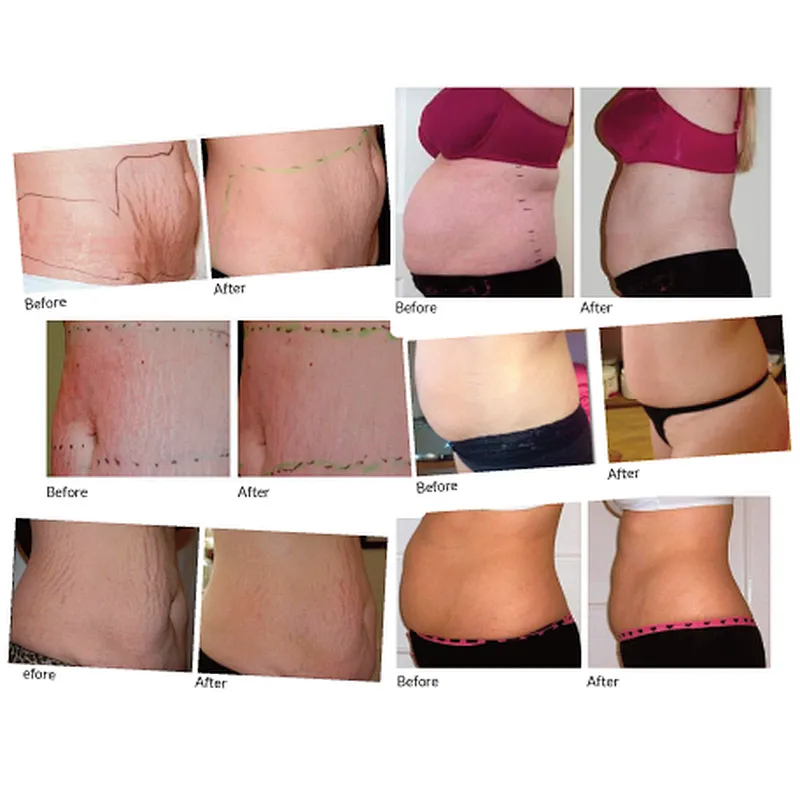 Fat Removal Body Slimming Machine  1470nm  Lipolysis Vaser Liposuction  Laser Lipoma Removal