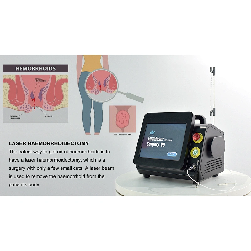 Laser  980nm 1470nm V6 Proctology Fistula Hemorrhoids Pilonidal Sinus