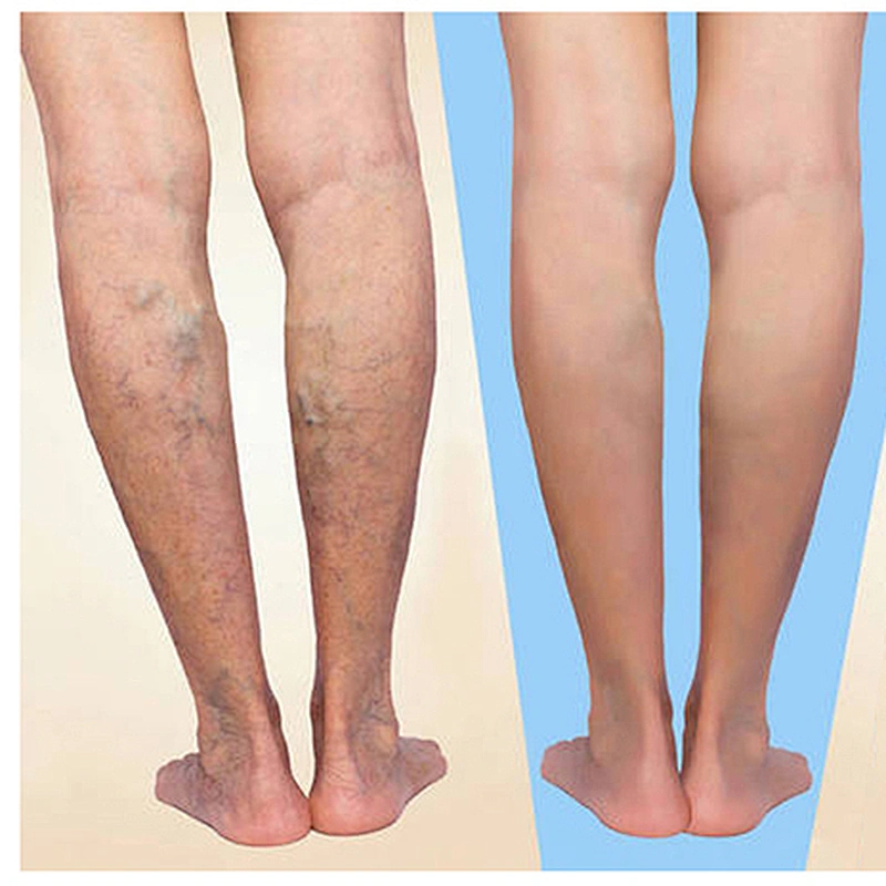 Hot Sale EVLT Diode Laser Spider Vein Removal Machine 980nm 1470nm Laser for Vascular Lesion Removal