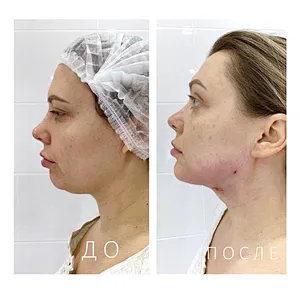 1470 Laser Lipolysis Face Lift Double Chin  Lipo Machine for Sale
