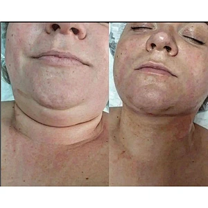 1470nm Machine Liposuction  Laser Plastic Surgery Endolaser Machine