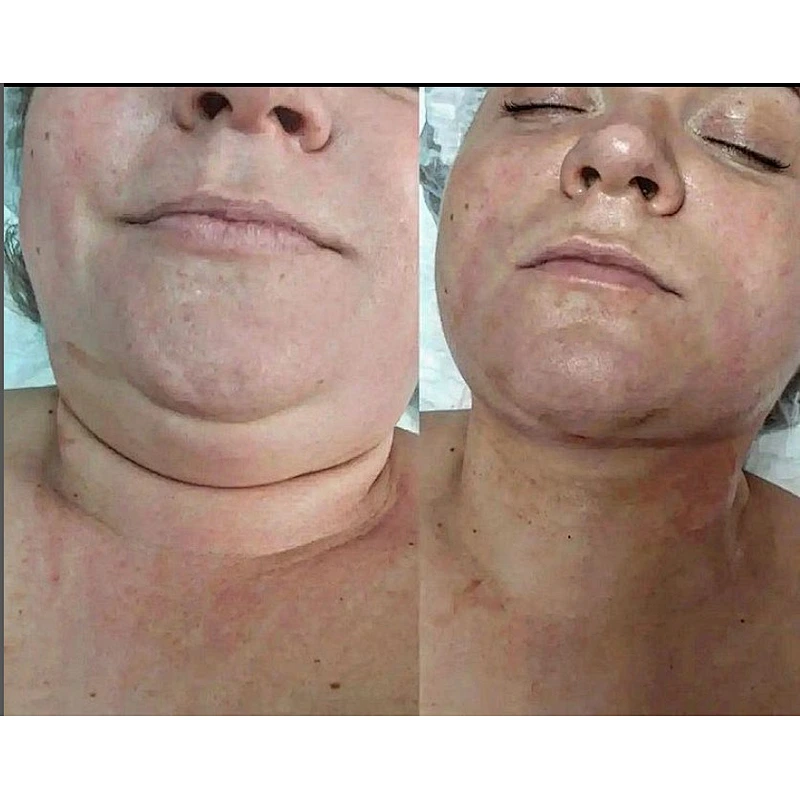 1470nm Machine Liposuction  Laser Plastic Surgery Endolaser Machine