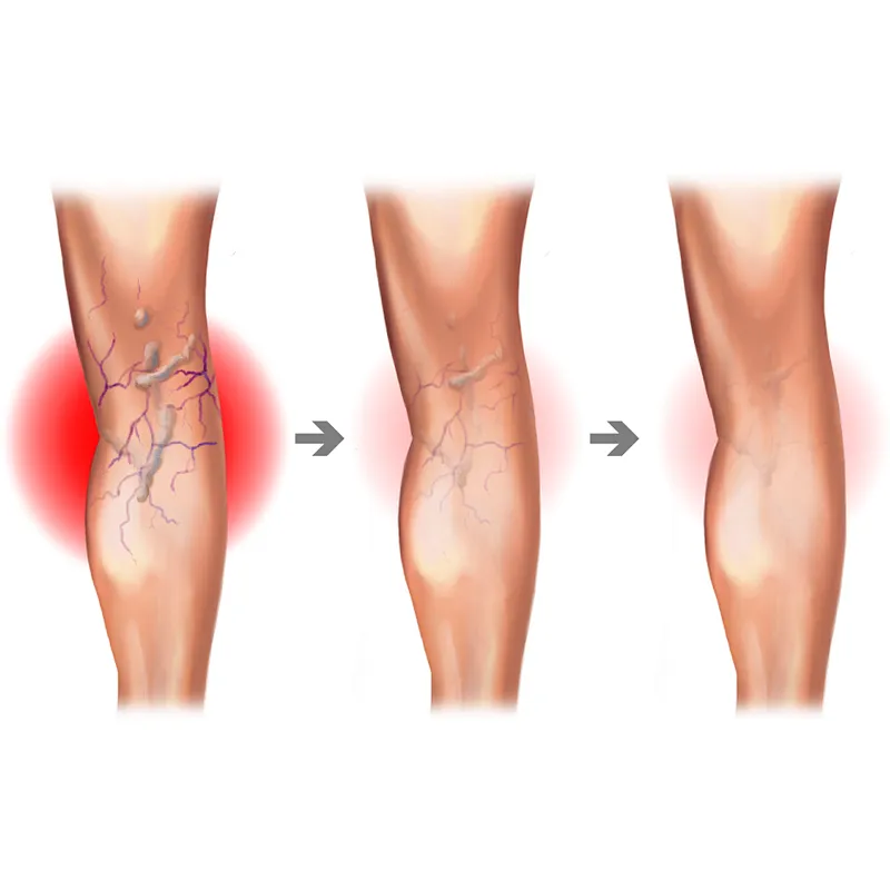 Intravenous Laser Ablation Laser EVLT EVLA  Leg Varicose Veins 1470nm  Laser Machine