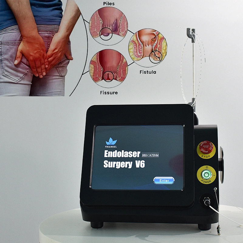 980nm1470nm Minimally Invasive Proctology Treatment Device Diode Laser Removal Hemorrhoids & Anal Fistula