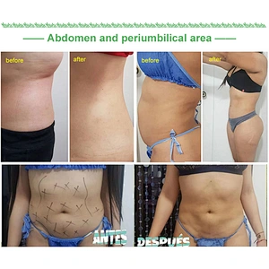 Best Price Italian Laser 1470nm Endoskin Lifting Tightening Rejuvenation Body Contouring Fat Reduction Diode Laser