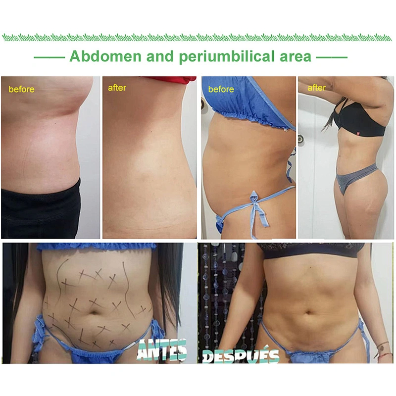 Best Price Italian Laser 1470nm Endoskin Lifting Tightening Rejuvenation Body Contouring Fat Reduction Diode Laser