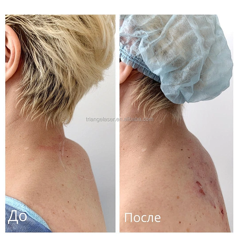 Fiber Laser 1470nm Lipo Laser Machine Liposuction Lipolysis 1470nm Skin Rejuvenation Laser Beauty Device
