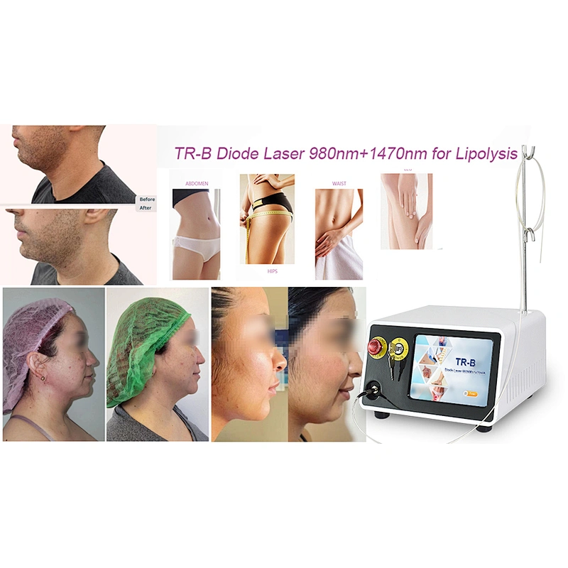 2024 Newest Endolaser 1470nm 980nm Diode Laser Face Lifting Liposuction Machine