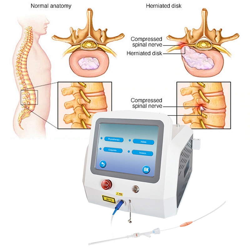 PLDD Laser 1470nm Treatment Surgery Fiber Percutaneous Laser Disc Decompression