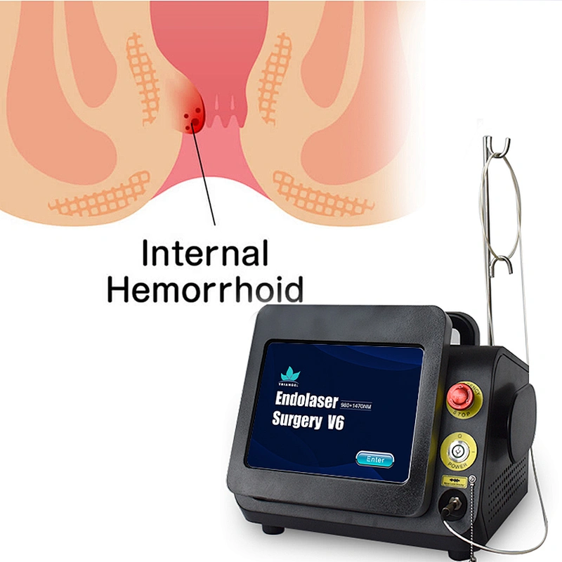 980nm 1470nm  Hemorrhoid Removal Laser  Machine Anal Fistula Haemorrhoids Laser Treatment