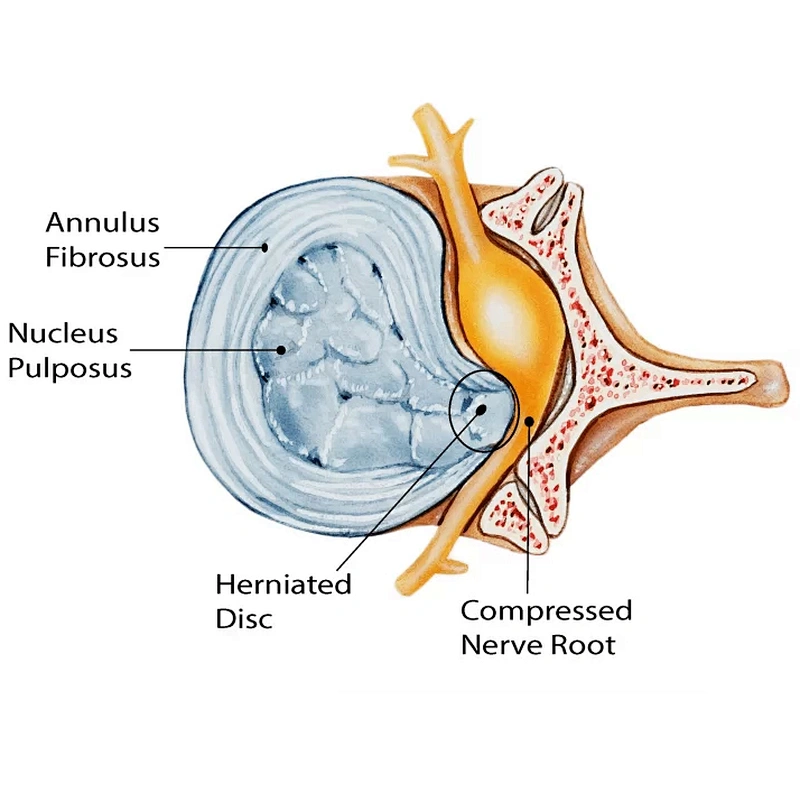 2024 the Hottest Machine PLDD Laser Treatment Diode Laser 980nm 1470nm for PLDD